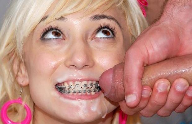 Teen Braces